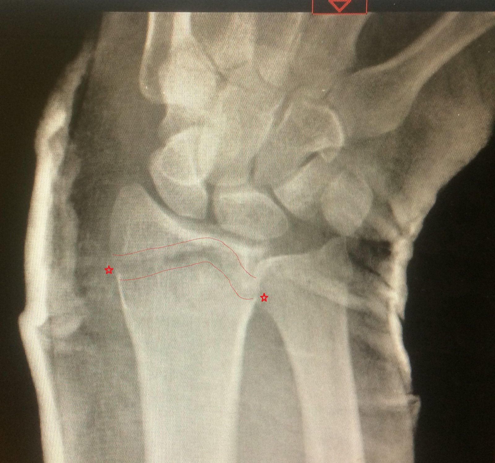 fracture.jpg