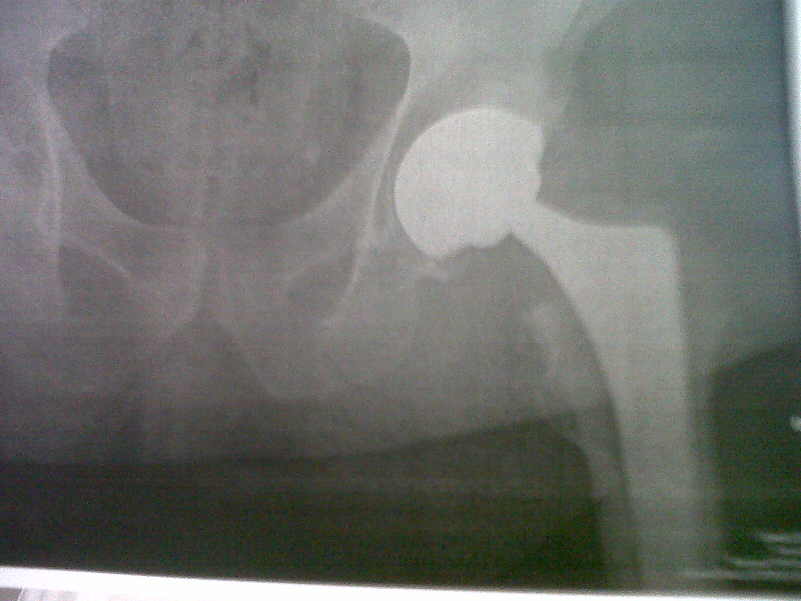 Hip X-ray.jpg
