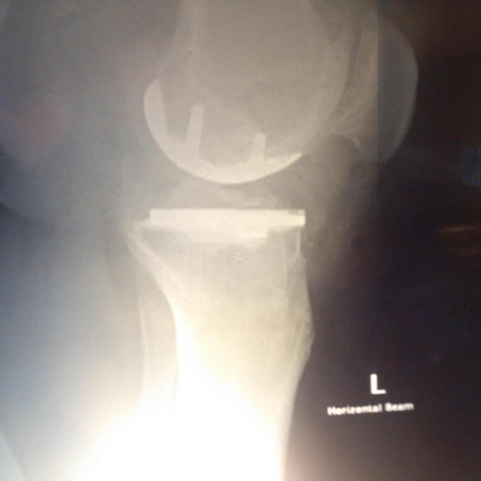 Knee X-ray.jpg