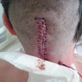 2nd operation wound