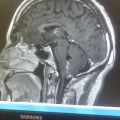 Brain Tumor 22nd feb 2017